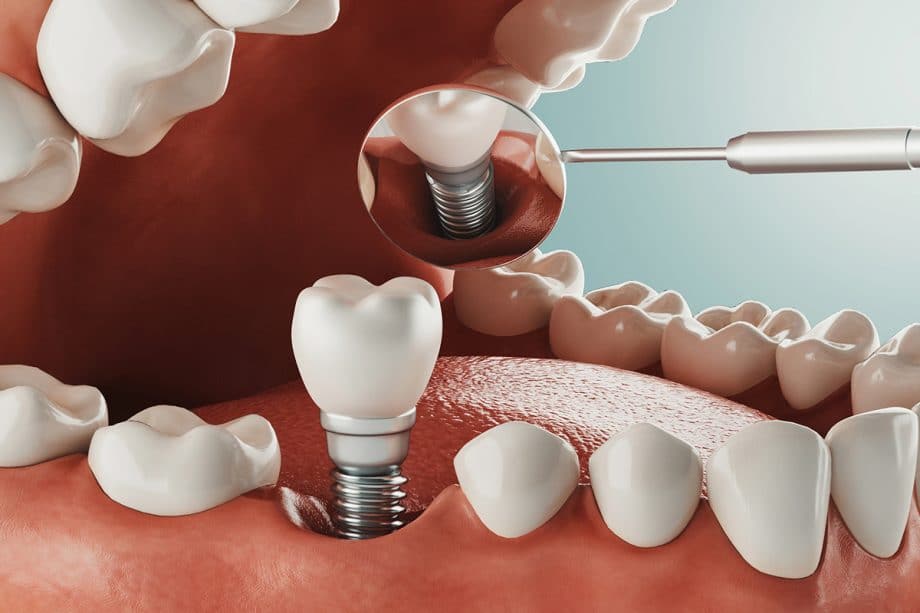 Est Ce Que La Pose D Un Implant Dentaire Fait Mal Comprendre La