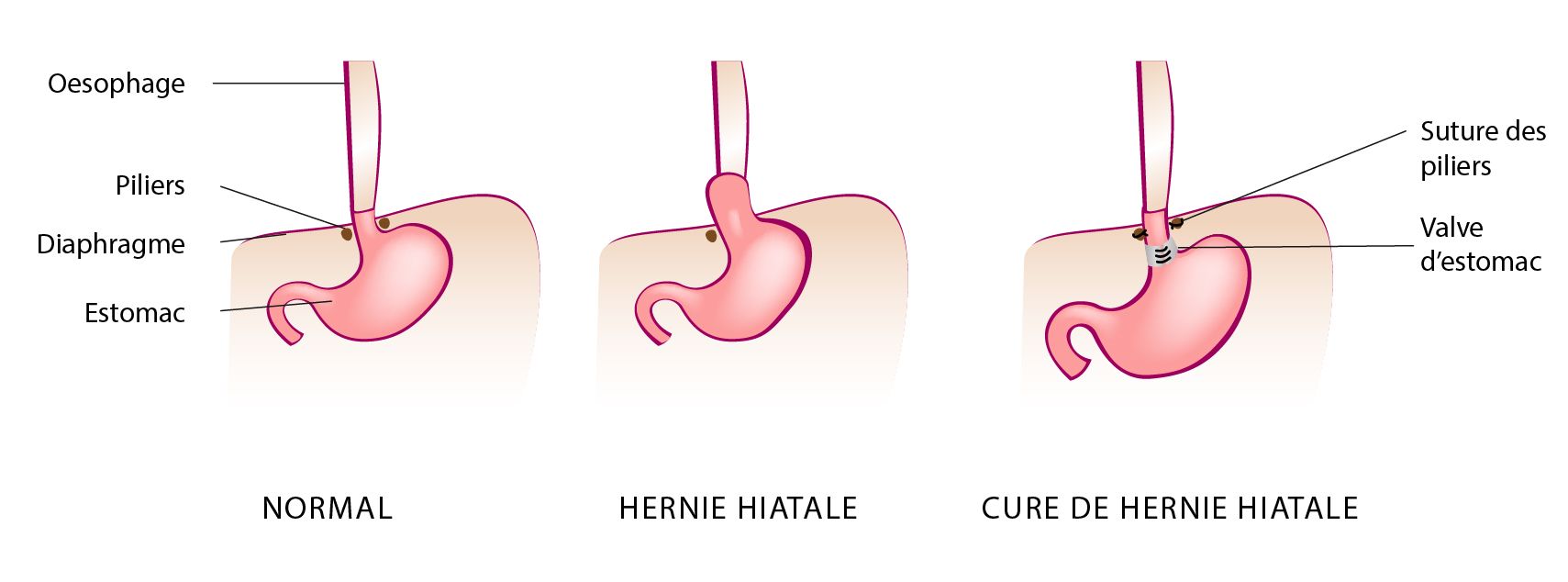 Hernies Hiatales Causes Symptômes Et Traitement