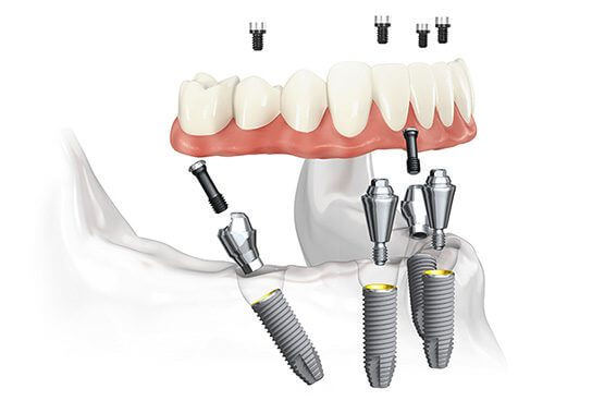 Implant dentaire All-on-4 montreal