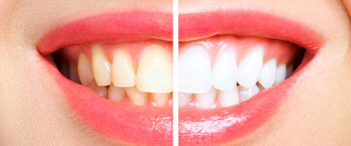 Teeth whitening Miami: What you need to know