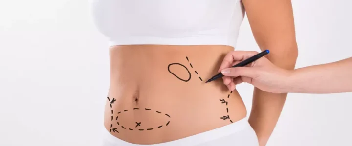 Cirugía estética de abdomen : opciones y resultados
