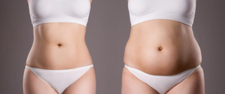 Liposuccion 1 Zone ou 2 Zones+Abdominoplastie